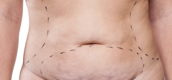 Tummy Tuck